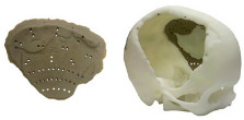 OsteoFab 3D Printed Skull